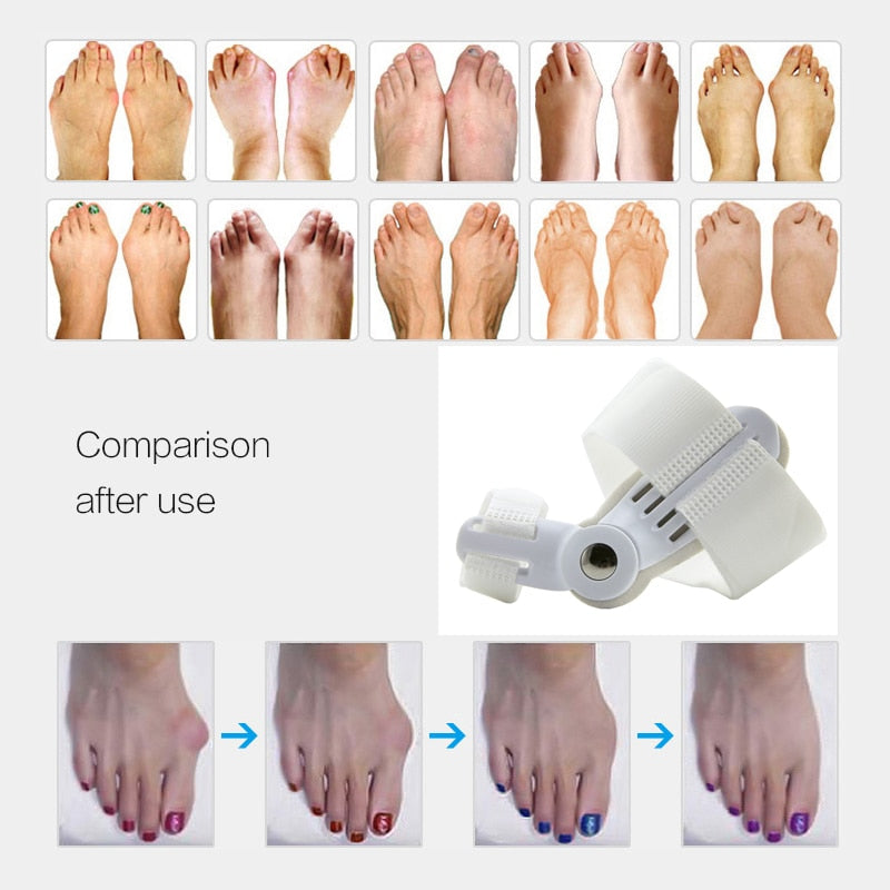 Hallux Valgus Bunion Corrector