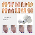 Hallux Valgus Bunion Corrector