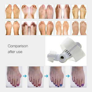 Hallux Valgus Bunion Corrector